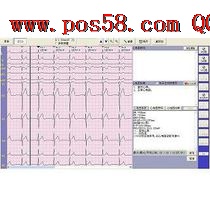 Analysis software / electrocardiography